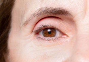 Kraaijenpootjes na de behandeling met botox