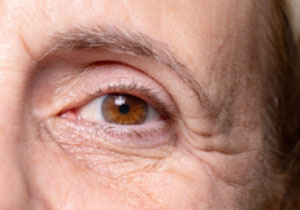 Kraaijenpootjes voor de behandeling met botox