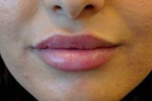 Lippen opvullen na de behandeling