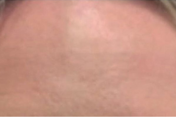 Voorhoofdrimpels na de botox behandeling
