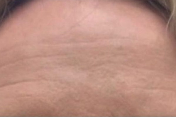 Voorhoofdrimpels voor de botox behandeling
